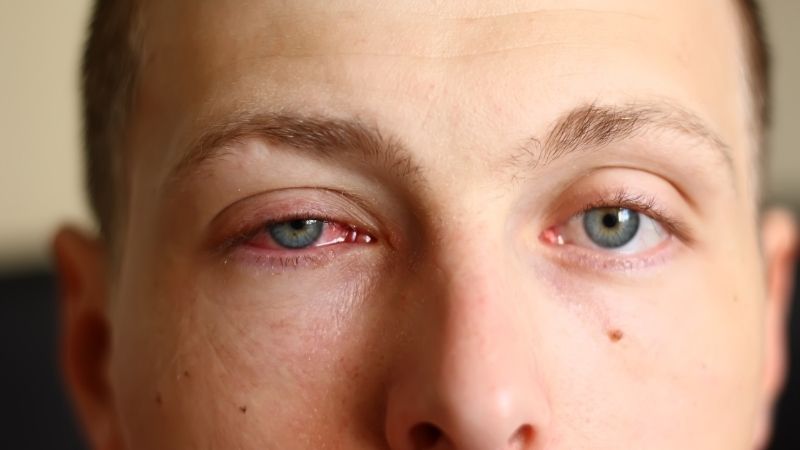 Treatment for Bacterial Conjunctivitis